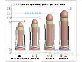 Как проводится увеличение пениса