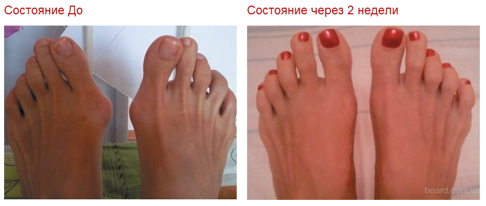 Корректор для большого пальца ноги отзывы